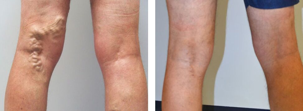 Zdjęcie przed i po użyciu Veniselle, doświadczenie w użyciu kremu