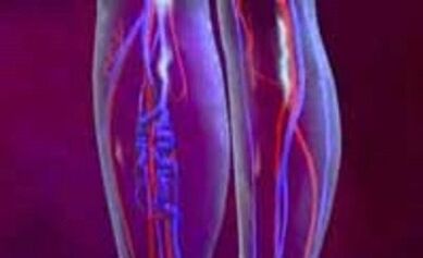 Przyczyny i leczenie żylaków