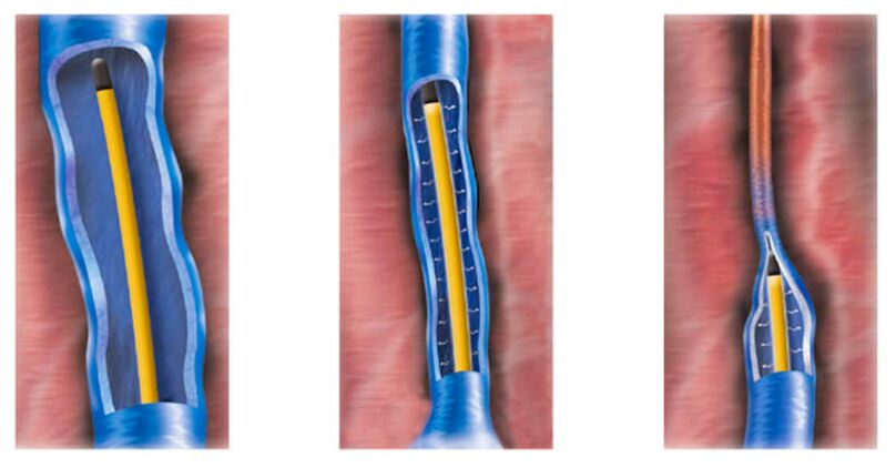 Ablacja prądem o częstotliwości radiowej jako metoda leczenia żylaków