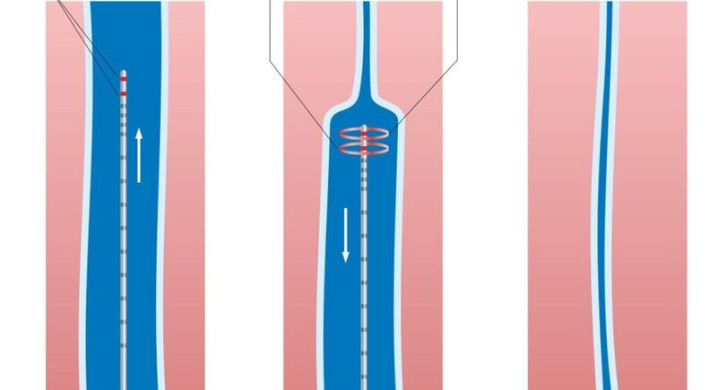 laserowe leczenie żylaków na nogach