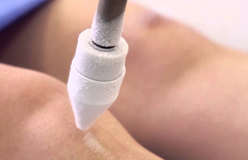 leczenie żylaków na nogach za pomocą krioterapii